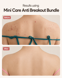 Mini Care Anti Breakout Bundle