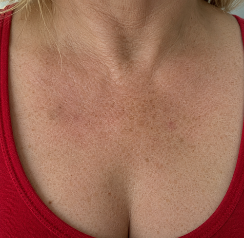 Before — Love Your Skin Again